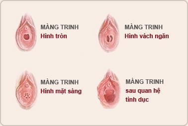 Hình ảnh màng trinh của con gái chưa rách và đã rách  Dịch vụ vá màng trinh