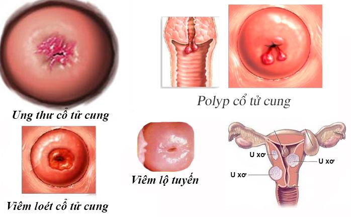 Bệnh polyp tử cung có nguy hiểm không?