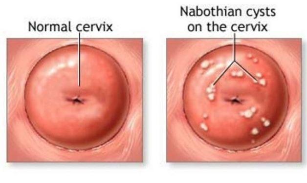 Nang naboth cổ tử cung và những điều chị em cần biết