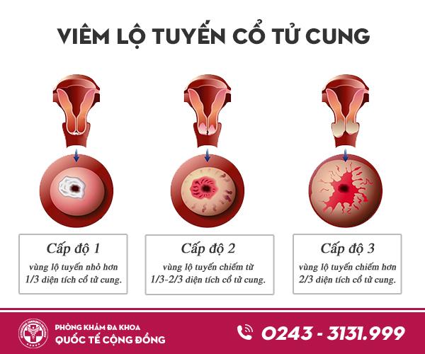 Viêm lộ tuyến độ 2 và cách chữa hiệu quả