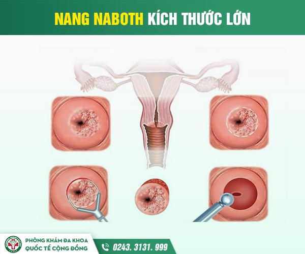 Hình ảnh nang naboth theo mức độ nặng nhẹ của nang naboth