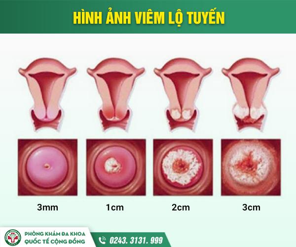 Kích thước viêm lộ tuyến và mức độ nguy hiểm có thể gặp phải khi ...