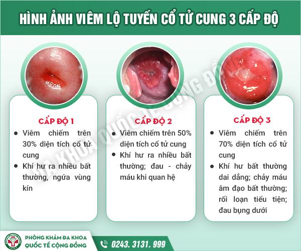 Tổng hợp] Hình ảnh viêm lộ tuyến cổ tử cung theo từng cấp độ của bệnh