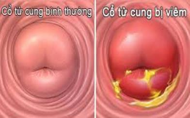 Viêm cổ tử cung và những vấn đề bạn cần biết