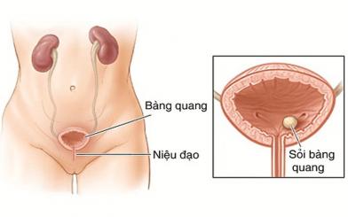 Một số Thông tin cần biết về bệnh viêm niệu đạo