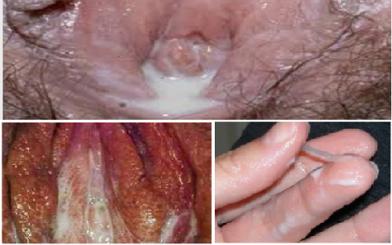 Đừng chủ quan với biến chứng của bệnh lậu ở nữ