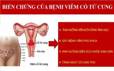 Nguy hại của bệnh viêm cổ tử cung bạn không nên chủ quan