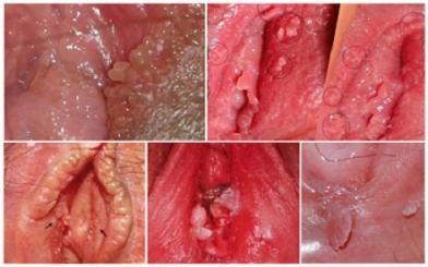 Bệnh s&ugrave;i m&agrave;o g&agrave; ở nữ nguy hiểm thế n&agrave;o?