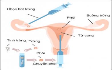 Bật mí một số biểu hiện của bệnh vô sinh nữ