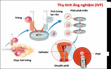 Các phương pháp điều trị bệnh vô sinh nữ