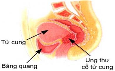 Cảnh báo: Bệnh viêm tử cung có nguy cơ gây vô sinh