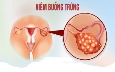 Tổng quan về bệnh vi&ecirc;m buồng trứng