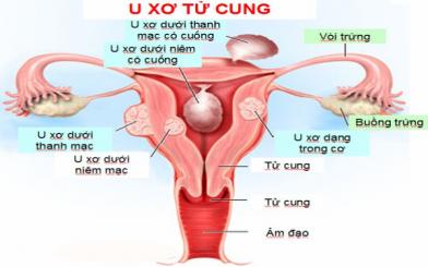 U xơ cổ tử cung là gì?