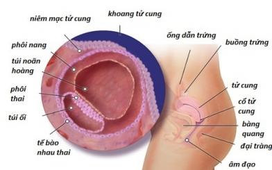 Triệu chứng của vi&ecirc;m ni&ecirc;m mạc tử cung