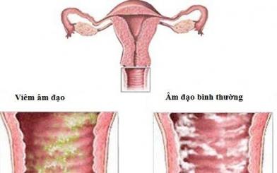 Bệnh viện chữa viêm âm đạo