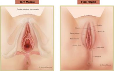 Thu nhỏ âm đạo ở đâu tốt và an toàn?