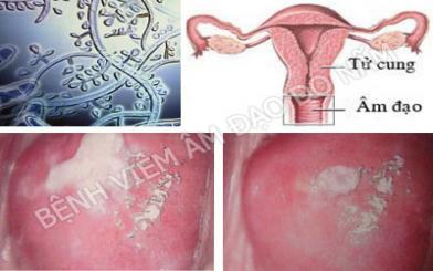 Viêm âm đạo Trichomonas là gì?