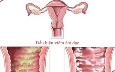 Những điều cần biết về bệnh viêm âm đạo ở nữ giới