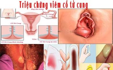 Cảnh b&aacute;o 7 triệu chứng vi&ecirc;m cổ tử cung bạn cần biết