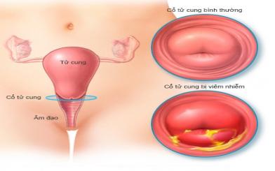 Vi&ecirc;m cổ tử cung nguy hiểm như thế n&agrave;o?