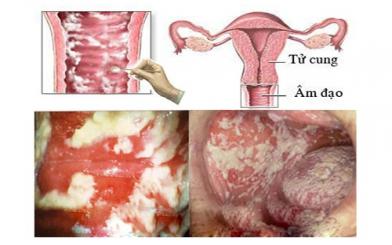 Viêm âm đạo bao gồm những bệnh viêm nhiễm nào?