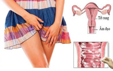 Ngứa vùng kín nữ - Không chủ quan với dấu hiệu bệnh