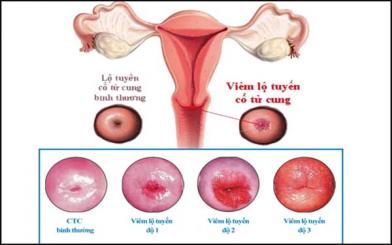 Vi&ecirc;m lộ tuyến cổ tử cung v&agrave; giải ph&aacute;p điều trị hiệu quả chuy&ecirc;n gia khuy&ecirc;n d&ugrave;ng