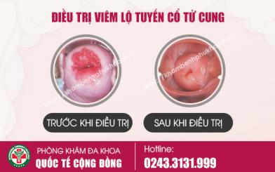 Tho&aacute;t khỏi nỗi &aacute;m ảnh bệnh vi&ecirc;m lộ tuyến nhờ c&aacute;ch chữa hiệu quả