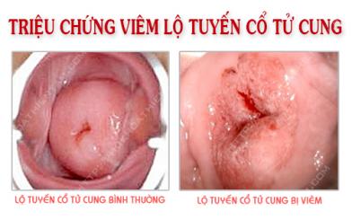 ​​​​​​​T&aacute;c hại vi&ecirc;m lộ tuyến cấp độ 1 kh&ocirc;ng thể chủ quan