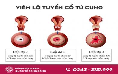 Vi&ecirc;m lộ tuyến độ 2 v&agrave; c&aacute;ch chữa hiệu quả