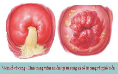 Bác sĩ chia sẻ cách chữa viêm cổ tử cung hiệu quả
