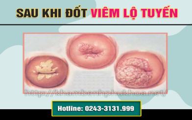 Đốt viêm lộ tuyến bao lâu thì khỏi? Có ảnh hưởng đến sinh sản không?