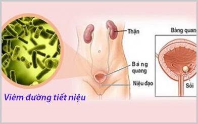 Phương ph&aacute;p hỗ trợ chữa bệnh vi&ecirc;m đường tiết niệu ở nữ giới hiệu quả
