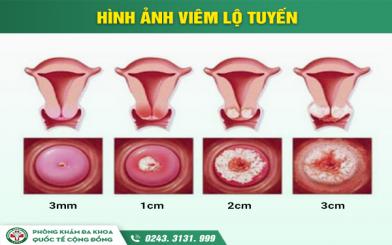 K&iacute;ch thước vi&ecirc;m lộ tuyến v&agrave; mức độ nguy hiểm c&oacute; thể gặp phải khi mắc bệnh