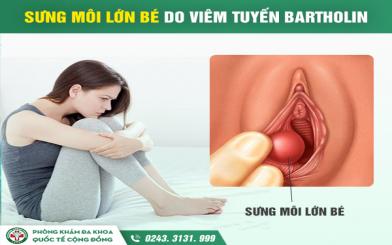Bài tổng hợp viêm nang Bartholin - Những điều quan trọng cần biết