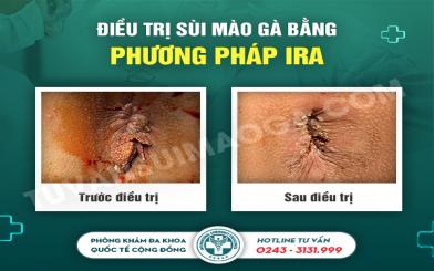 Chia sẻ về bệnh s&ugrave;i m&agrave;o g&agrave; ở hậu m&ocirc;n v&agrave; c&aacute;ch chữa hiệu quả - B&aacute;c sĩ Đỗ Quang Thế